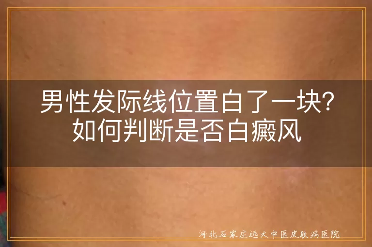 男性发际线,白斑,白癜风,观察,专业检查,治疗,心态