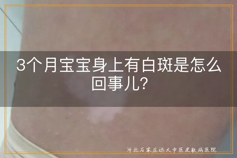 3个月宝宝,白斑,白色糠疹,湿疹后色素脱失,无色素性痣,白癜风,缺乏微量元素