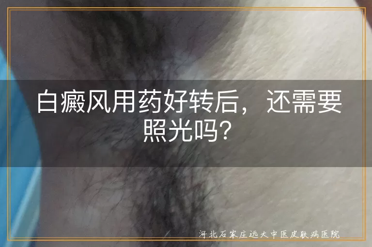 白癜风,照光治疗,黑色素细胞,复发,饮食调整,适当锻炼,心理调适