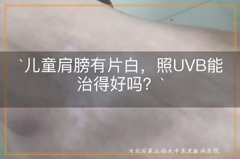 儿童白斑,UVB光疗,白癜风,窄谱UVB,治疗计划,专业指导