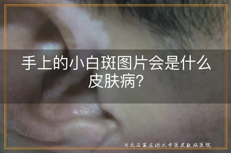 手上小白斑,白癜风,汗斑,白色糠疹,贫血痣,皮肤病,治疗