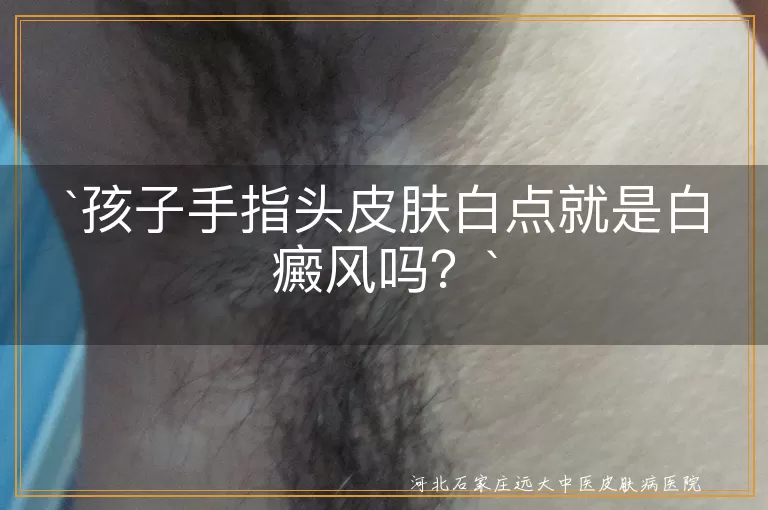 白癜风,手指头白点,汗斑,手癣,虫咬反应,营养不良,就医检查