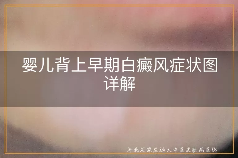 婴儿白癜风,早期症状,白斑,扩散,就医,心理关怀,日常护理,积极治疗