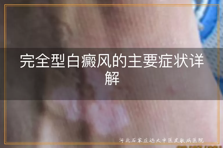 完全型白癜风,皮肤白斑,毛发变白,边界清晰,白斑扩散,皮肤萎缩,局部瘙痒,心理健康