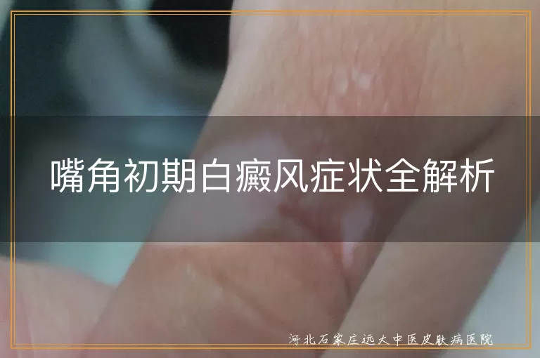 嘴角白癜风,初期症状,白斑,毛发变化,局部瘙痒,及时就医