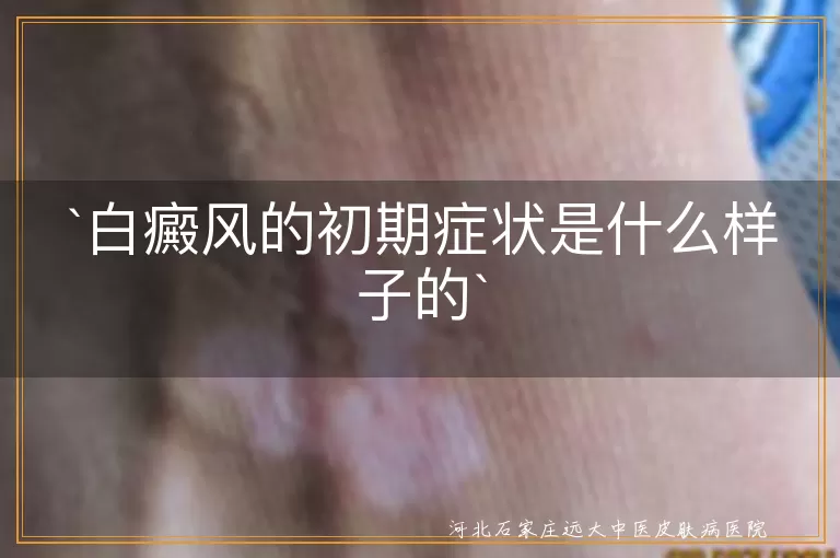 白癜风,初期症状,浅白色斑块,乳白色斑块,逐渐扩大,形状各异,敏感,无痛无痒,影响美观