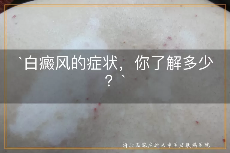 白癜风,白斑,增多,扩大,瘙痒,脱屑,特殊类型,影响