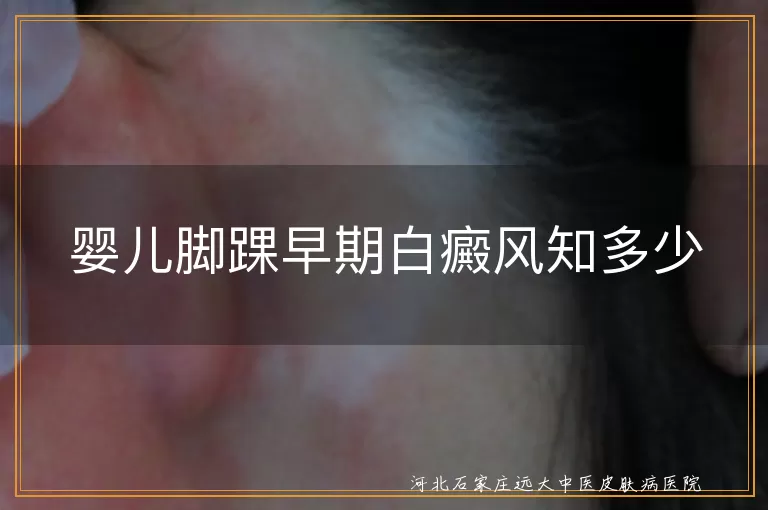 婴儿白癜风,脚踝,早期症状,白斑,遗传因素,自身免疫,预防措施,就医