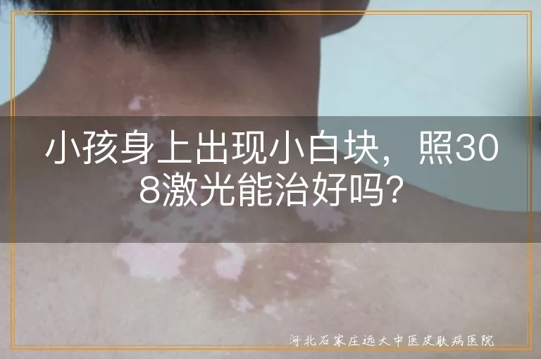 小孩,小白块,白癜风,308激光治疗,安全性,周期性治疗,日常护理,预防复发