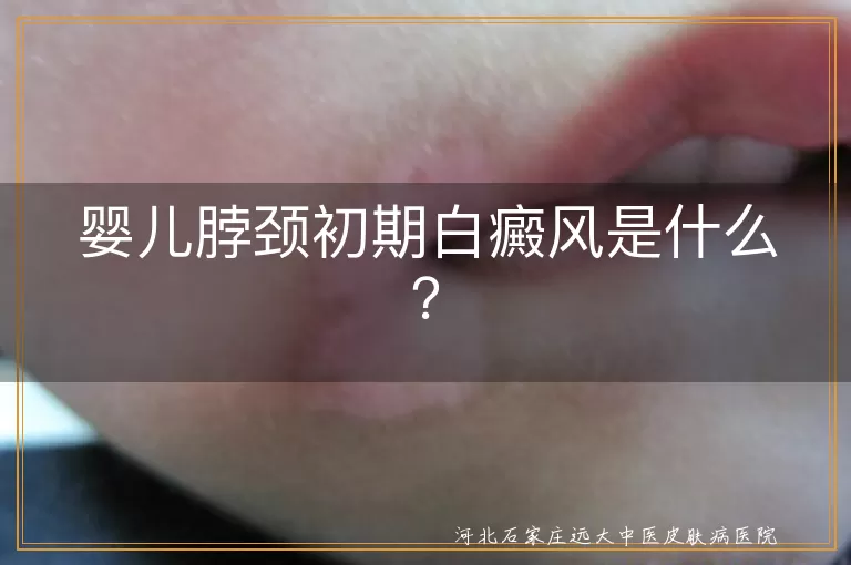 婴儿脖颈,初期白癜风,症状,原因,预防,治疗