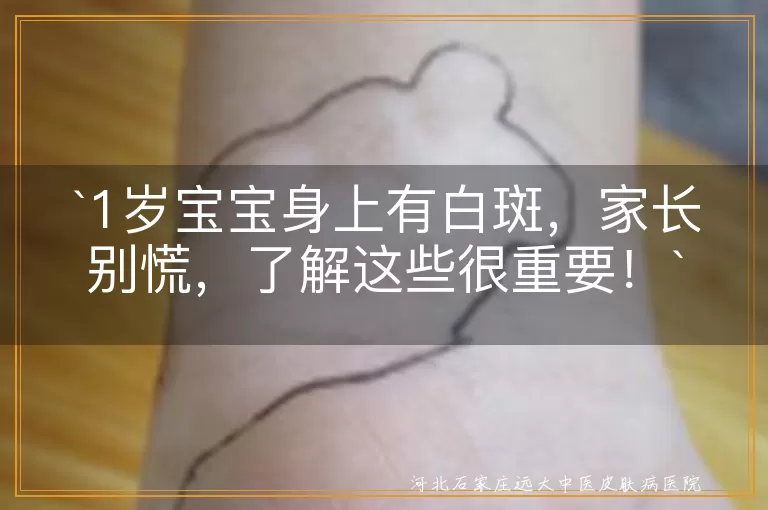 1岁宝宝,白斑,白色糠疹,花斑癣,无色素痣,贫血痣,白癜风,就医,对症治疗,日常护理,心理关怀