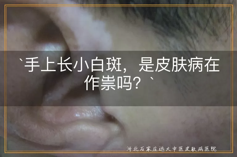 手上小白斑,皮肤病,色素减退斑,白癜风,汗斑