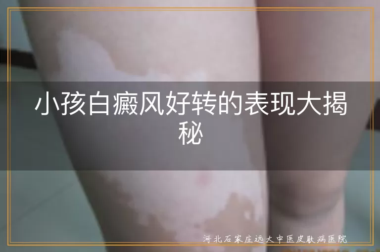 小孩白癜风,好转表现,皮肤颜色恢复,白斑面积缩小,边缘清晰,感觉功能恢复,毛发生长,消退期症状减轻