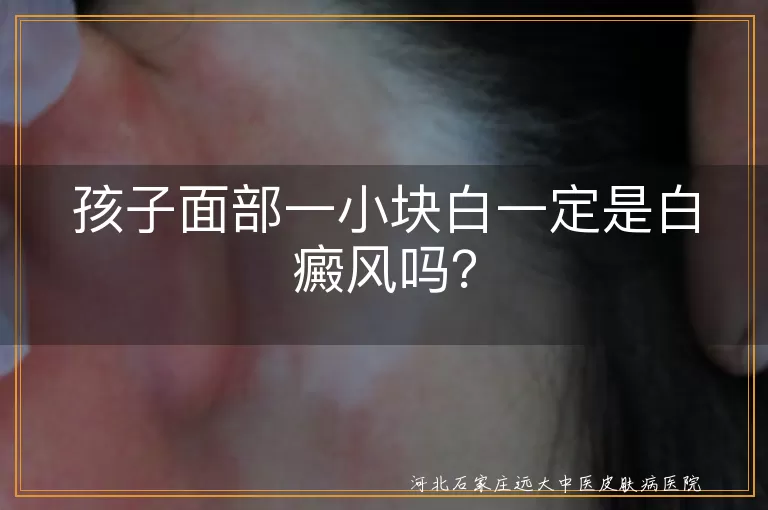 孩子面部白斑,白癜风,白色糠疹,无色素痣,贫血痣,花斑癣,皮肤护理,均衡饮食