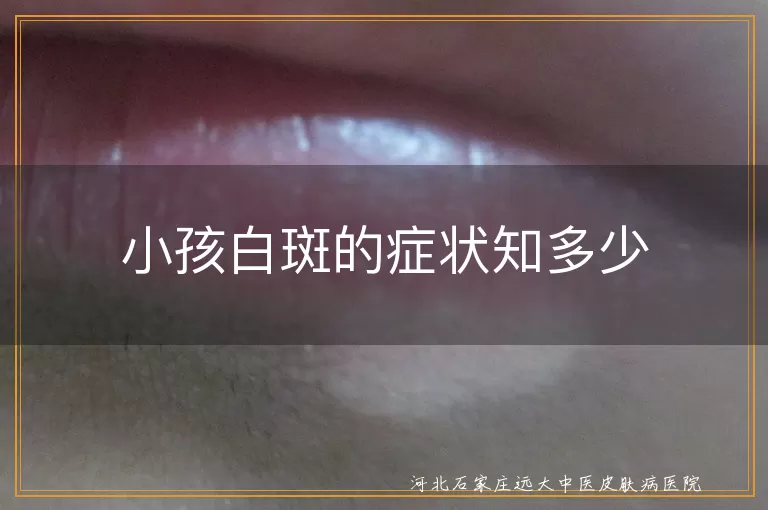 小孩白斑,皮肤变化,毛发变白,瘙痒,红肿脱屑,视力下降,白癜风,白色糠疹,无色素痣,花斑癣