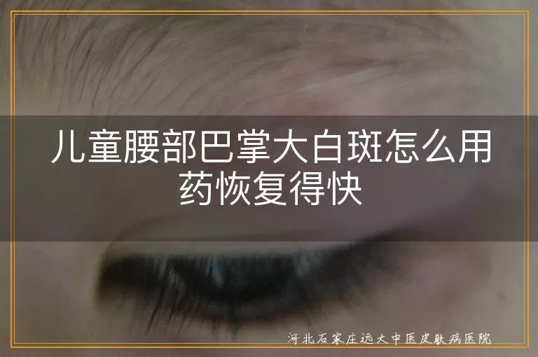 儿童腰部白斑,合理用药,恢复,白癜风,光疗,日常护理