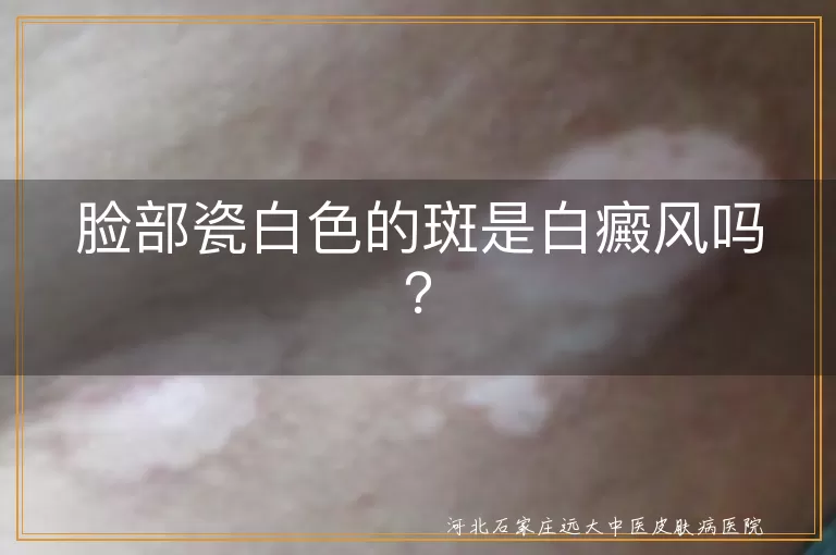 瓷白色斑,白癜风,花斑癣,白色糠疹,诊断,治疗,预防