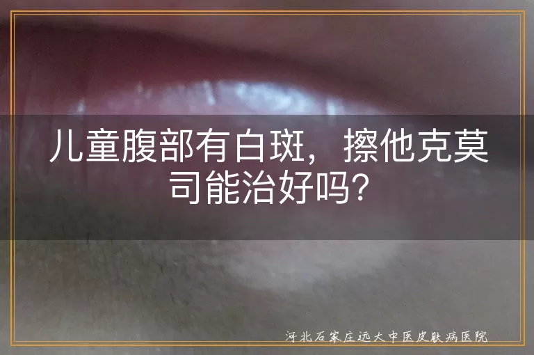 儿童白斑,他克莫司软膏,白癜风,治疗,注意事项,日常护理