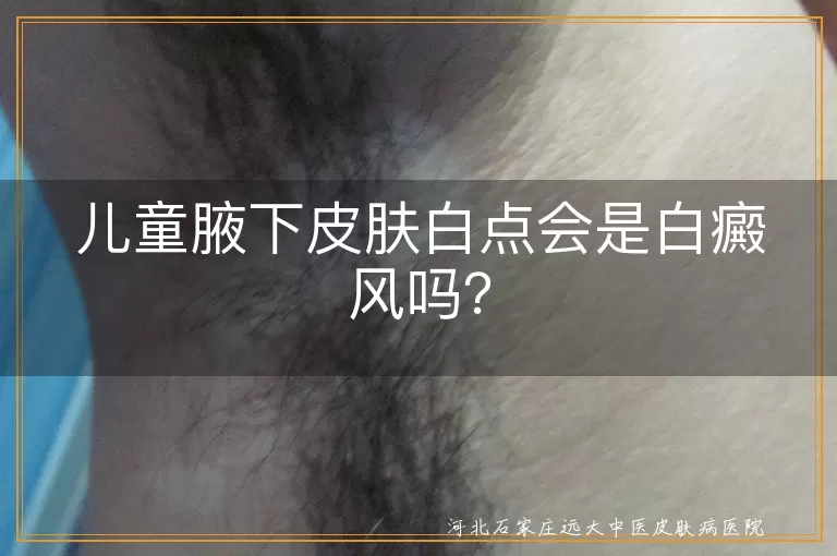 儿童腋下白点,白癜风,白色糠疹,无色素痣,贫血痣,花斑癣,就医检查,日常护理