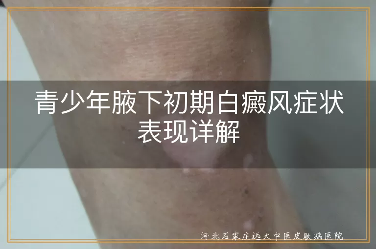 青少年,腋下,初期,白癜风,症状,治疗,心态