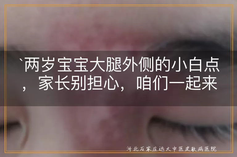 两岁宝宝,大腿外侧,小白点,皮肤干燥,轻微皮炎,色素不均,白癜风,看医生,日常护理
