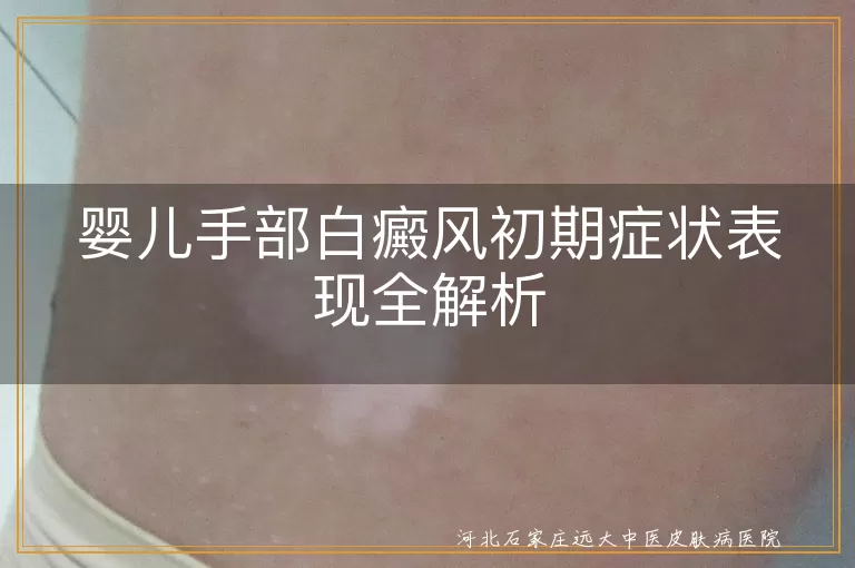 婴儿白癜风,手部白斑,初期症状,诊断,治疗,日常护理,心理健康