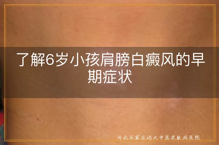 白癜风,6岁小孩,肩膀,早期症状,色素减退,白斑,就医,心理健康,日常护理
