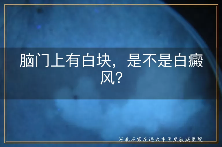 脑门白块,白癜风,白色糠疹,花斑癣,贫血痣,老年性白斑,治疗,就医检查