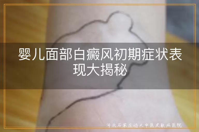 婴儿白癜风,面部症状,淡白色斑点,表面光滑,及时就医