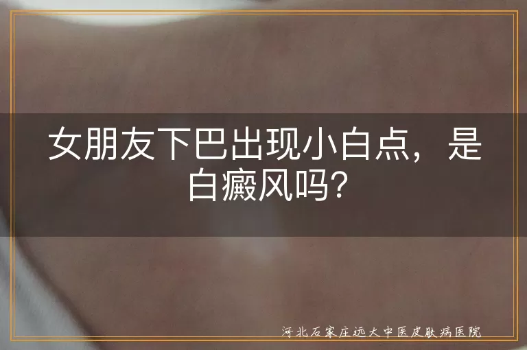 白癜风,下巴小白点,花斑癣,白色糠疹,就医,日常护理