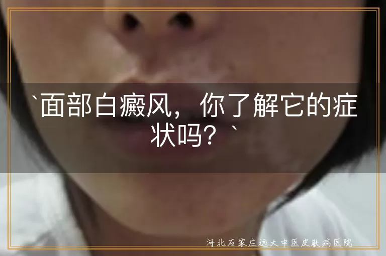面部白癜风,白斑,影响形象,白斑扩散,毛发变白,皮肤敏感,情绪问题,治疗,护理