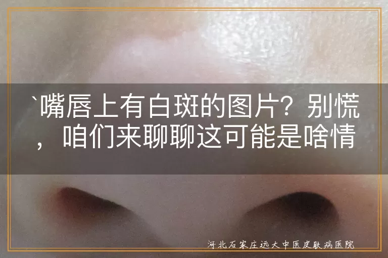 嘴唇白斑,唇炎,色素减退,口腔溃疡,医生就诊,日常护理