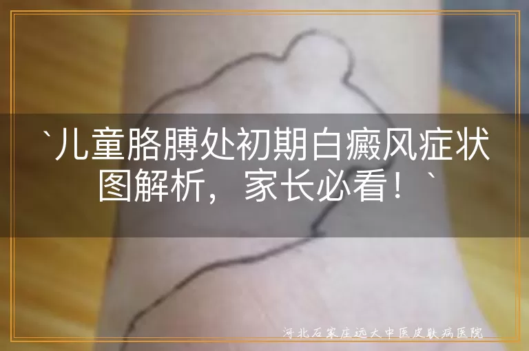 儿童,胳膊,白癜风,初期症状,小白点/斑,逐渐扩大,不痛不痒,皮肤光滑,治疗,预防