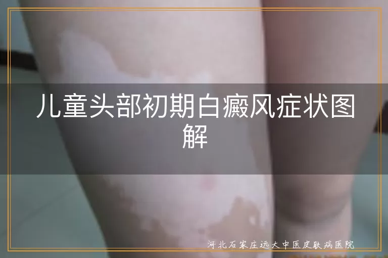 儿童白癜风,头部初期症状,白斑,头发变白,轻微瘙痒,及时就诊