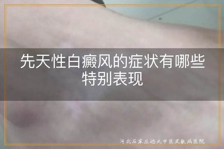 先天性白癜风,皮肤颜色变化,毛发变化,白斑扩散,不适感,其他症状