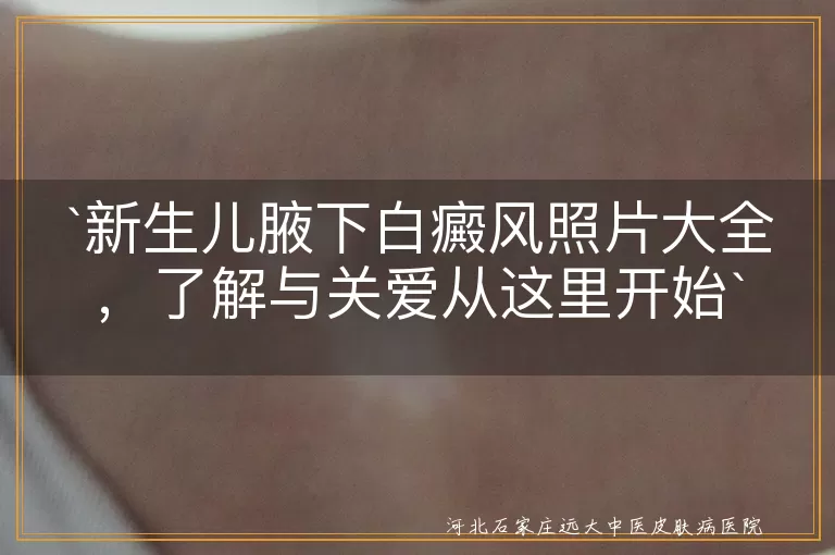 新生儿,腋下白癜风,照片大全,黑色素