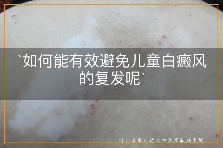 如何能有效避免儿童白癜风的复发呢