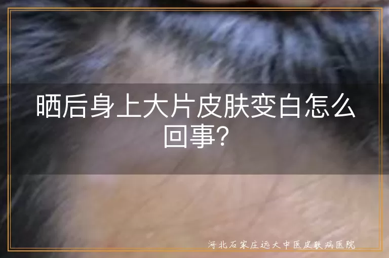 晒后皮肤变白,紫外线损伤,黑色素代谢异常,防晒,晒后修复,补水,皮肤病