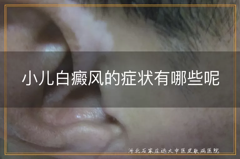小儿白癜风,皮肤白斑,症状,就医,治疗,日常护理