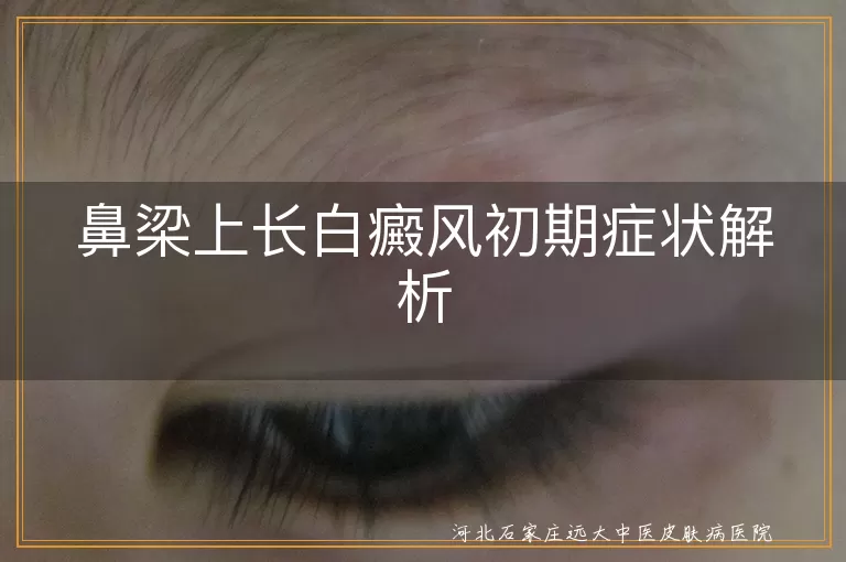 鼻梁,白癜风,初期症状,白斑,色素减退,就医,治疗,日常护理,心理调适