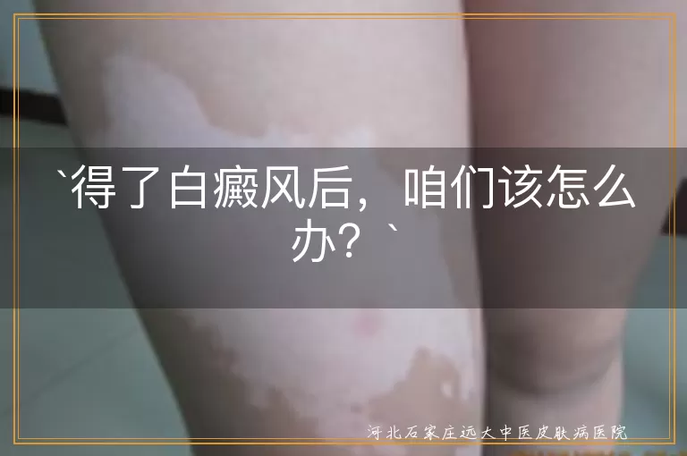 白癜风,治疗措施,及时就医,药物治疗,光疗,激光治疗,中医调理,心理治疗,生活调护
