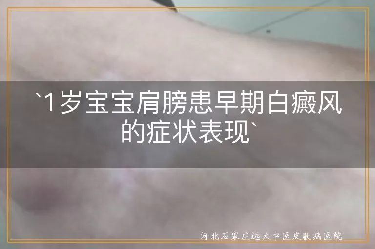 1岁宝宝,肩膀,早期白癜风,白斑,症状表现,防晒,治疗