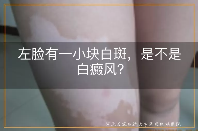 白癜风,左脸白斑,脂肪粒,白色糠疹,花斑癣,贫血痣,无色素痣,日光性白斑,就医,皮肤护理