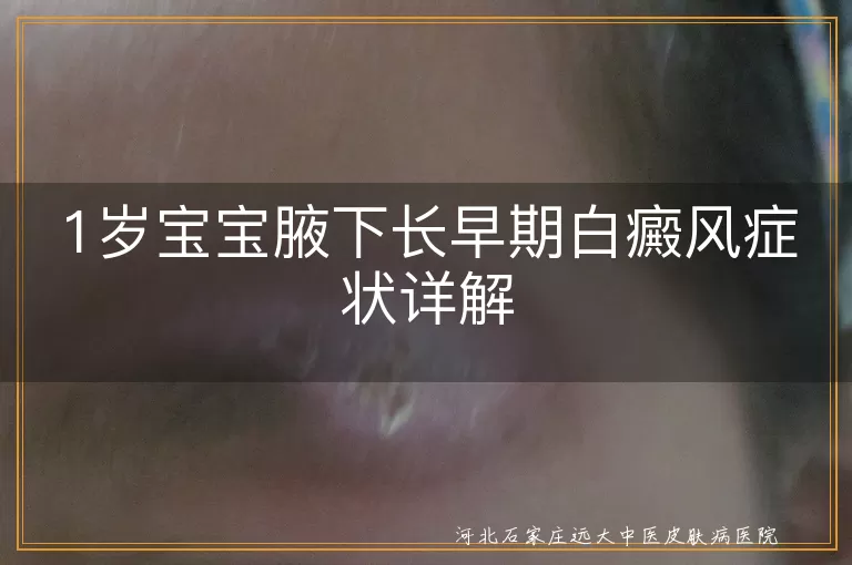 1岁宝宝,腋下,白癜风,色素减退斑,就医治疗