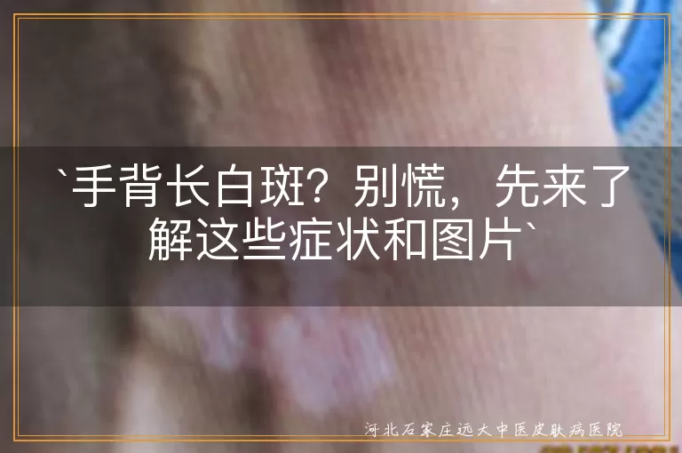 手背白斑,老年性白斑,日晒斑,缺乏微量元素,白癜风,判断方法,治疗措施