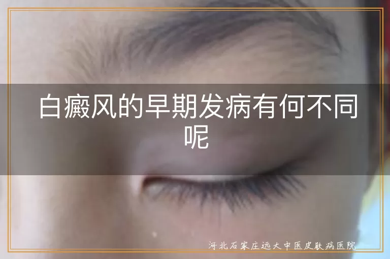 白癜风,早期发病,白斑,毛发变色,紫外线敏感,治疗