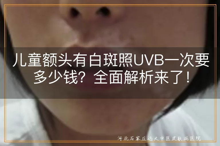 儿童白斑,UVB光疗,费用,专业指导,防护措施,治疗方式