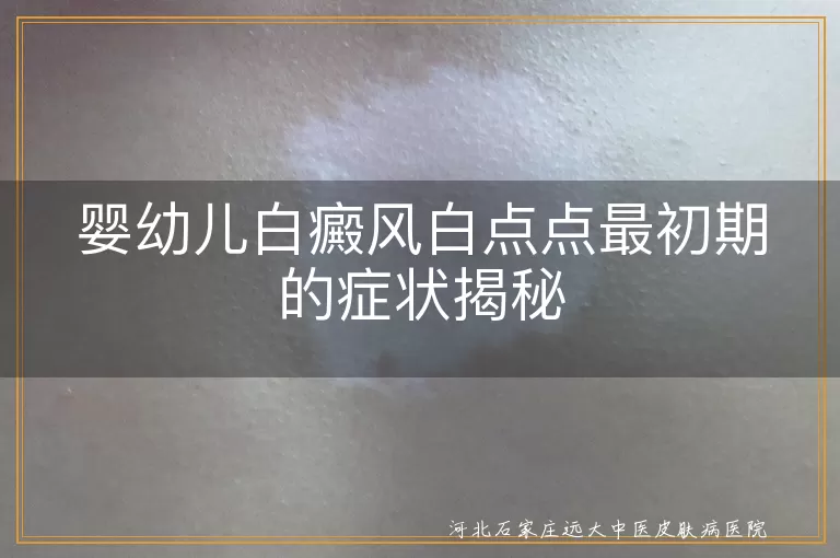 婴幼儿白癜风,白点点,初期症状,边界色素沉着带,及时就医