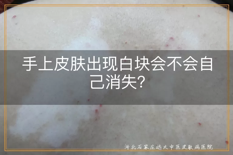 手上白块,血液循环不畅,炎症后色素减退斑,白色糠疹,白癜风,汗斑,就医治疗,预防