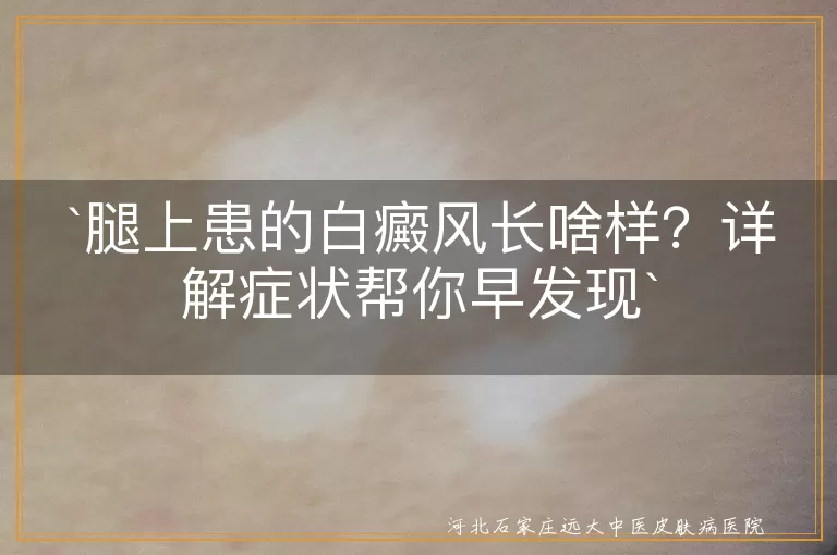 腿上白癜风,白斑,扩散,边缘,触感,伴随症状,早发现早治疗